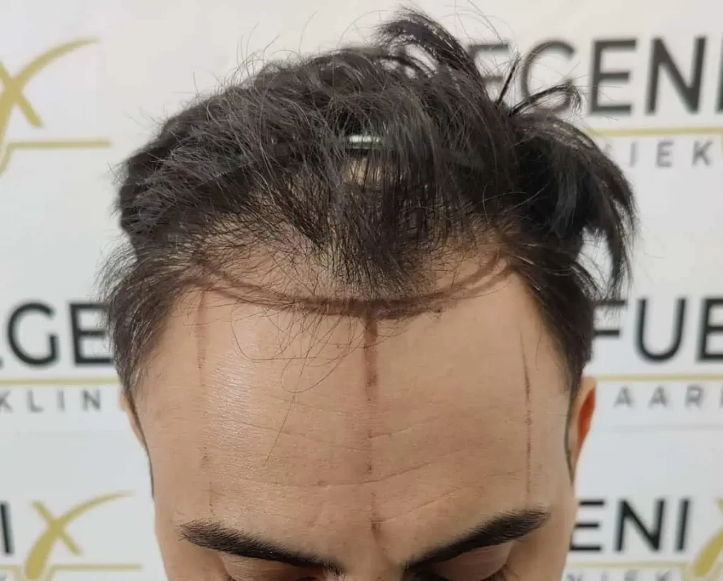 The Bollywood Hairline