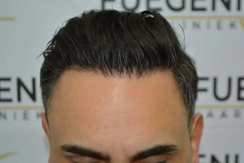 The Bollywood Hairline