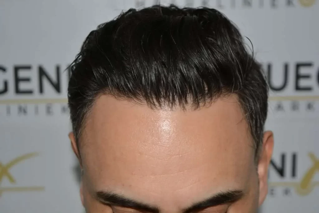 The Bollywood Hairline