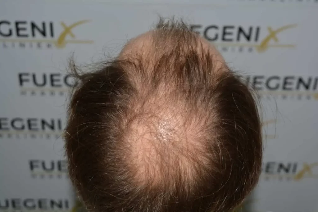 Front Midscalp In One Sitting