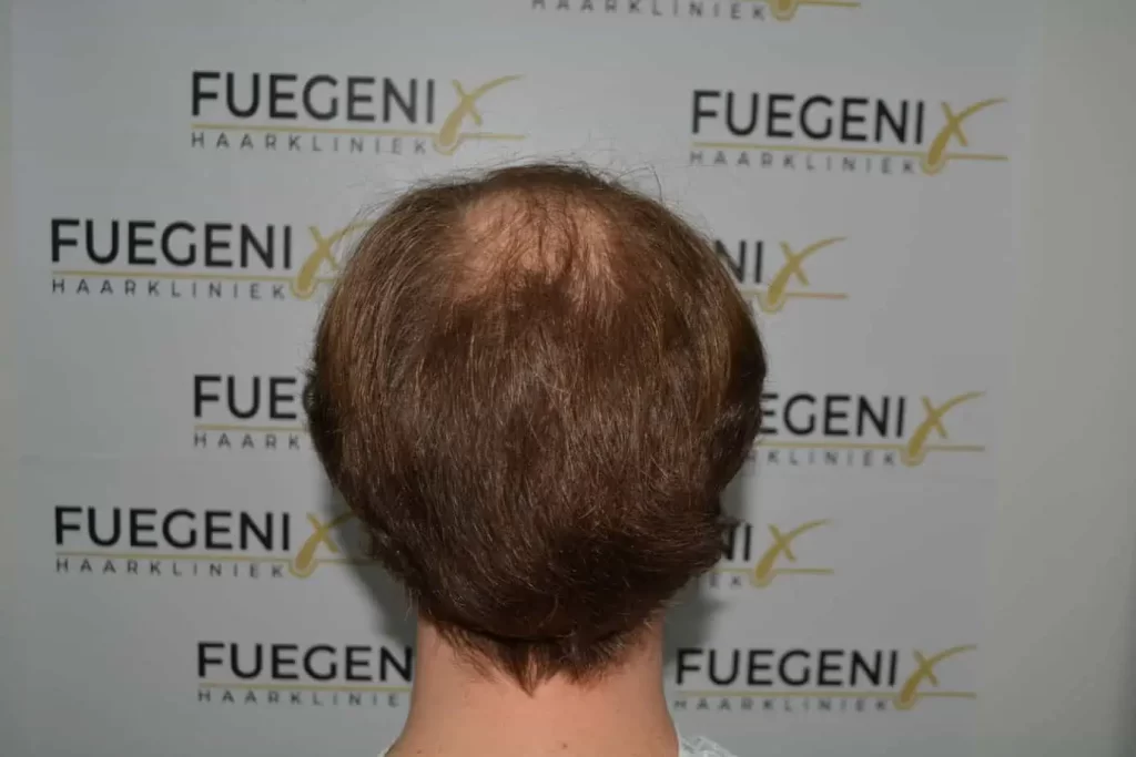 Front Midscalp In One Sitting