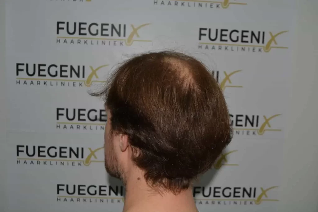 Front Midscalp In One Sitting