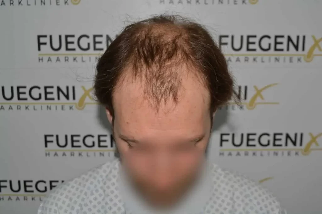 Front Midscalp In One Sitting