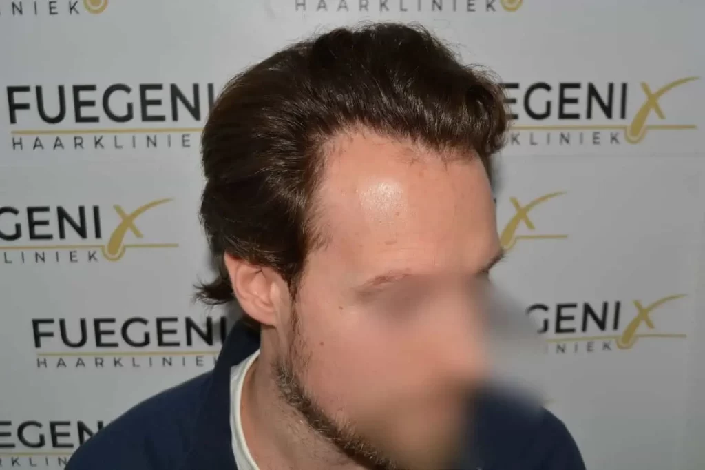 Front Midscalp In One Sitting
