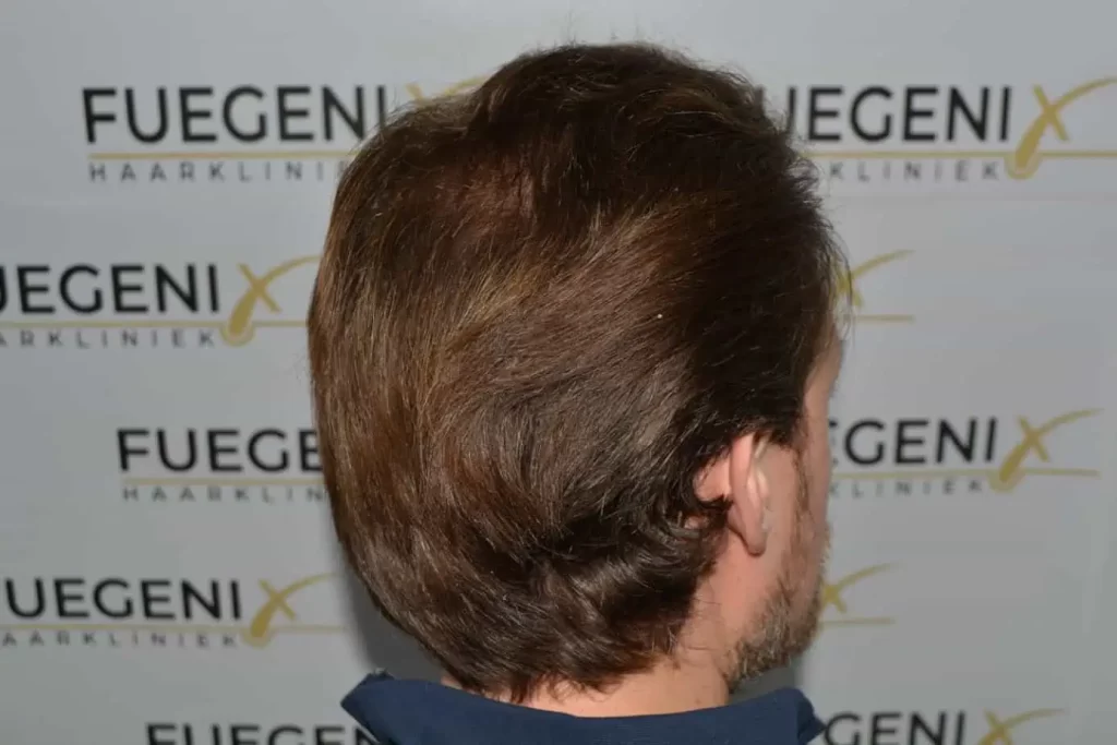 Front Midscalp In One Sitting