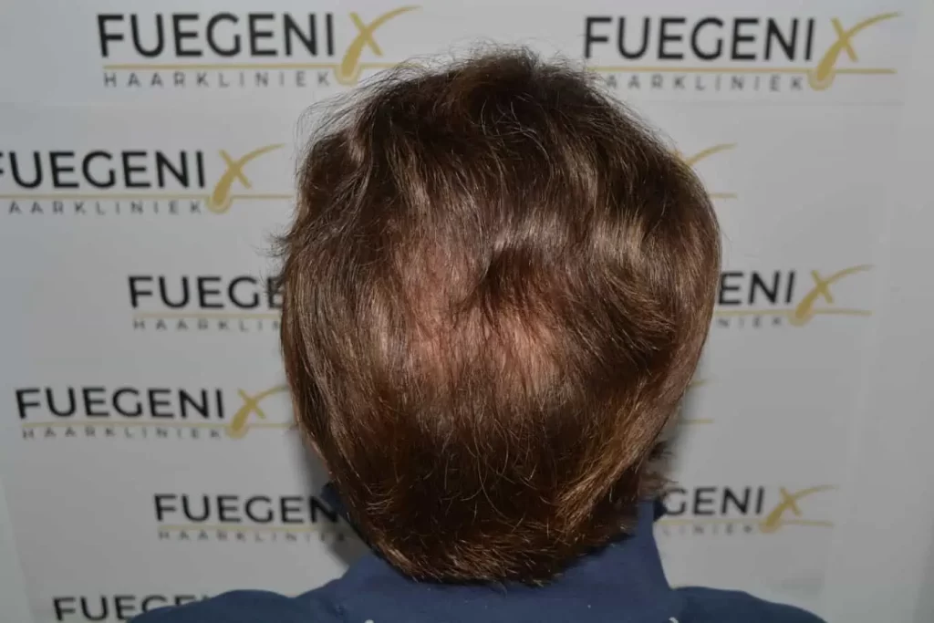 Front Midscalp In One Sitting
