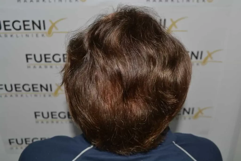 Front Midscalp In One Sitting