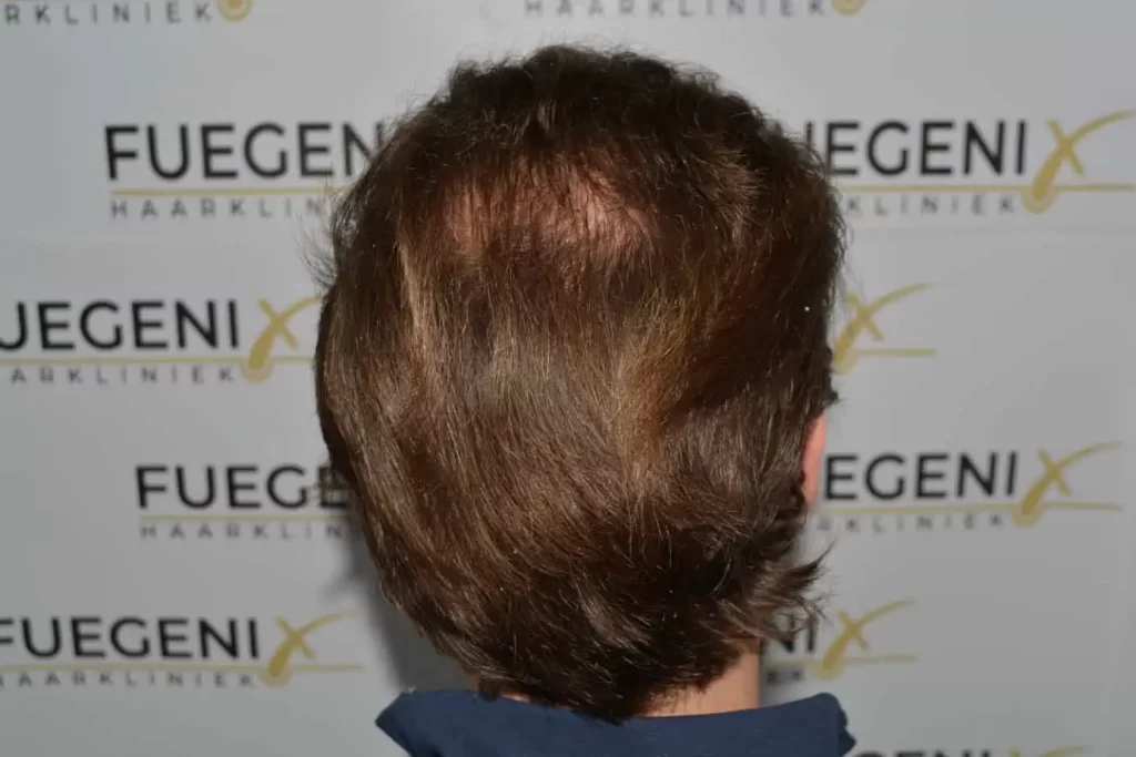 Front Midscalp In One Sitting
