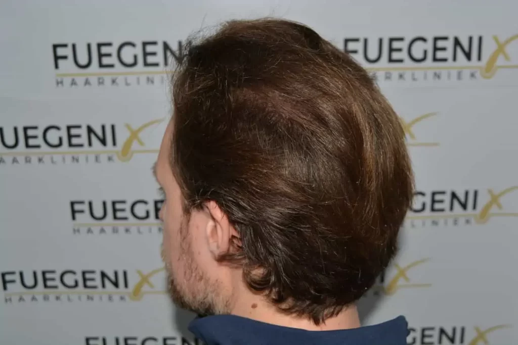 Front Midscalp In One Sitting