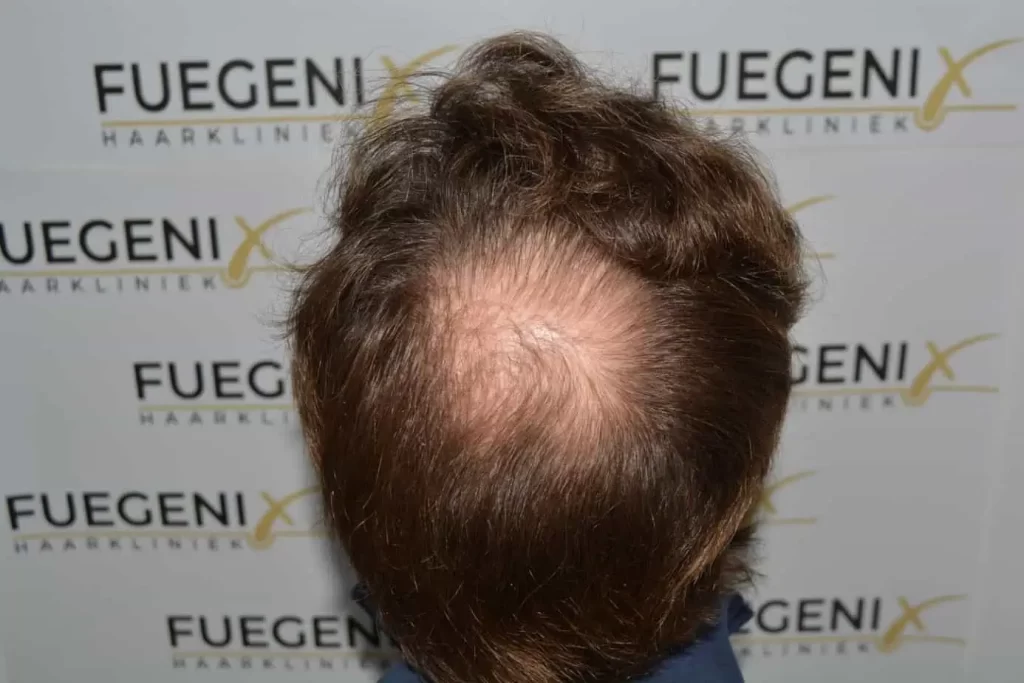Front Midscalp In One Sitting