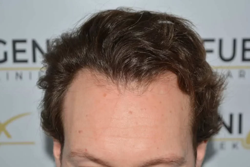 Front Midscalp In One Sitting