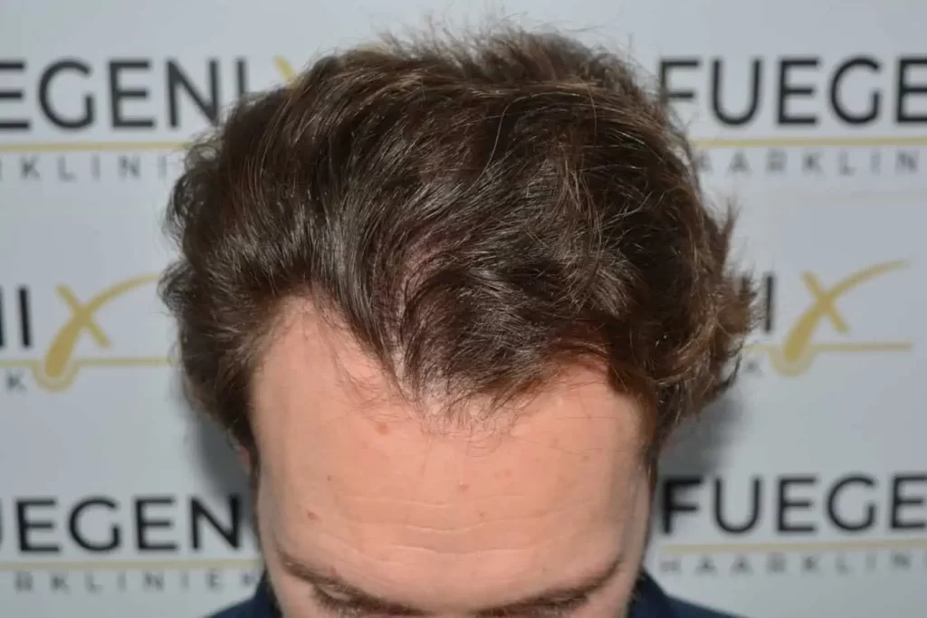 Front Midscalp In One Sitting