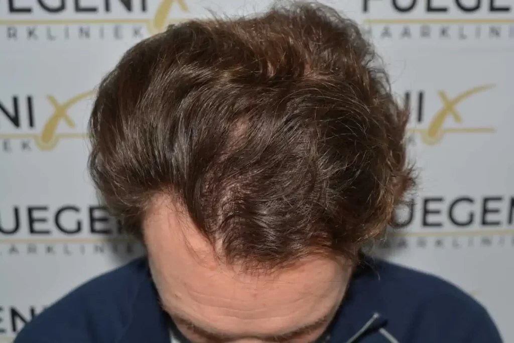 Front Midscalp In One Sitting