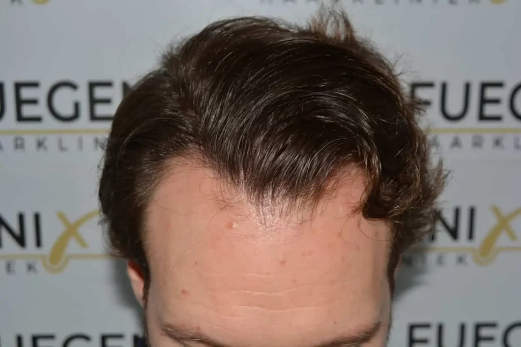 Front Midscalp In One Sitting