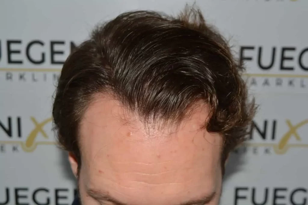 Front Midscalp In One Sitting