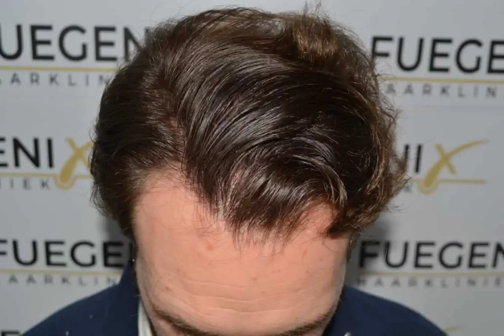 Front Midscalp In One Sitting