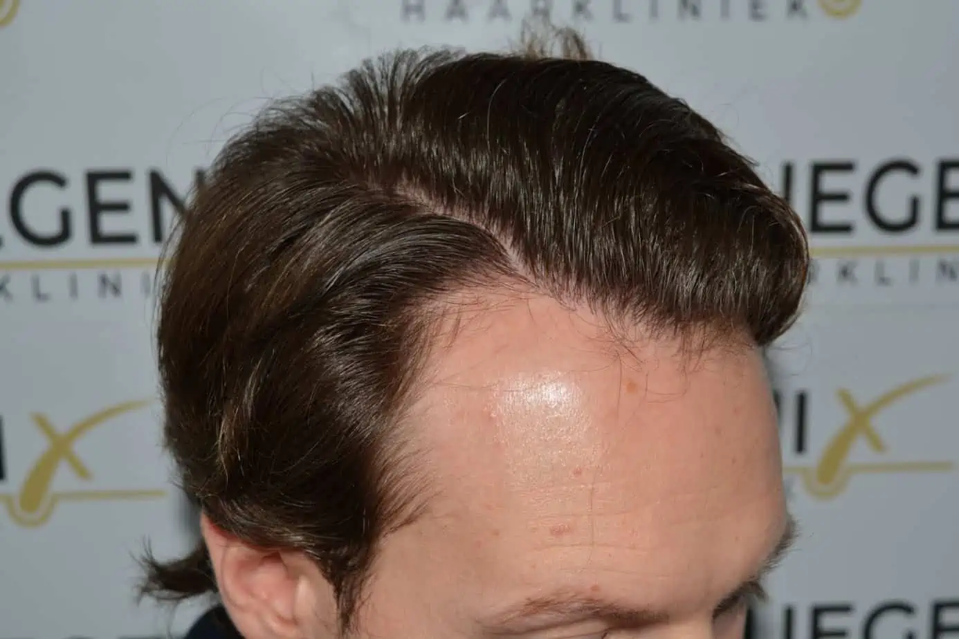 Front midscalp in one sitting — after
