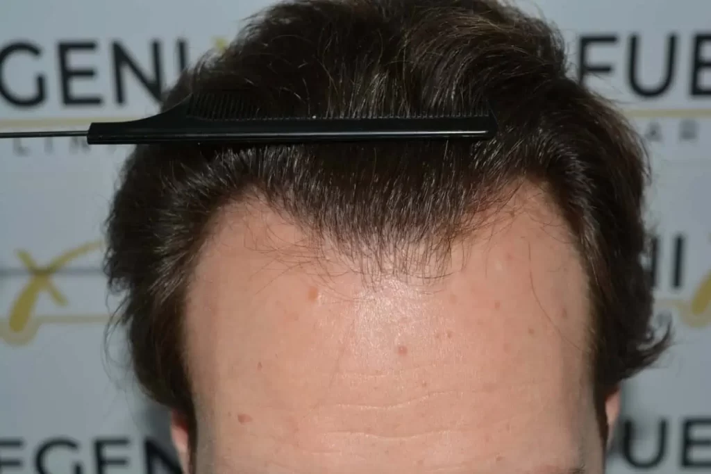 Front Midscalp In One Sitting