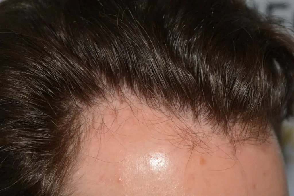 Front Midscalp In One Sitting