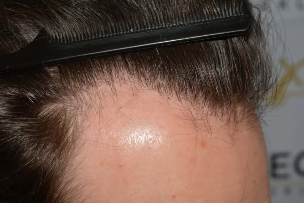 Front Midscalp In One Sitting