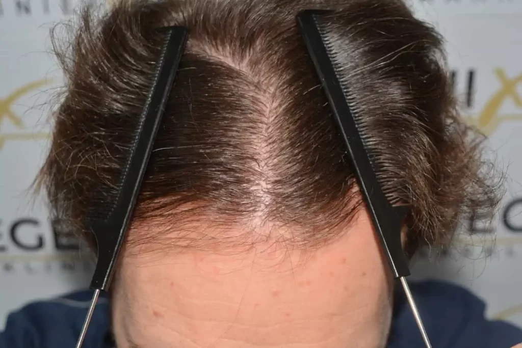 Front Midscalp In One Sitting