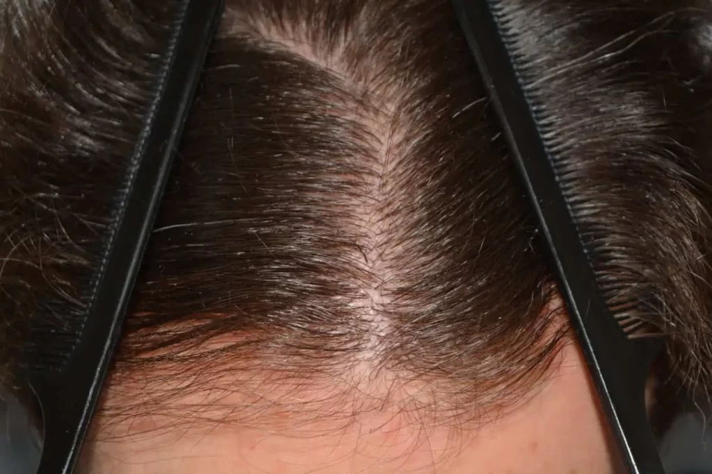 Front Midscalp In One Sitting