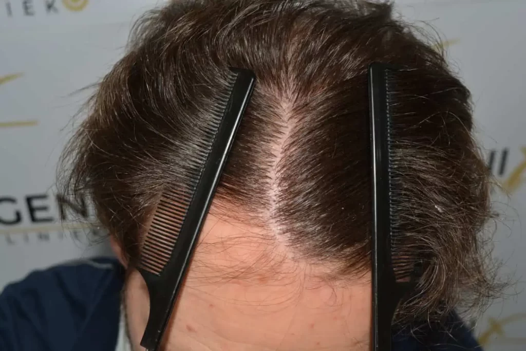 Front Midscalp In One Sitting