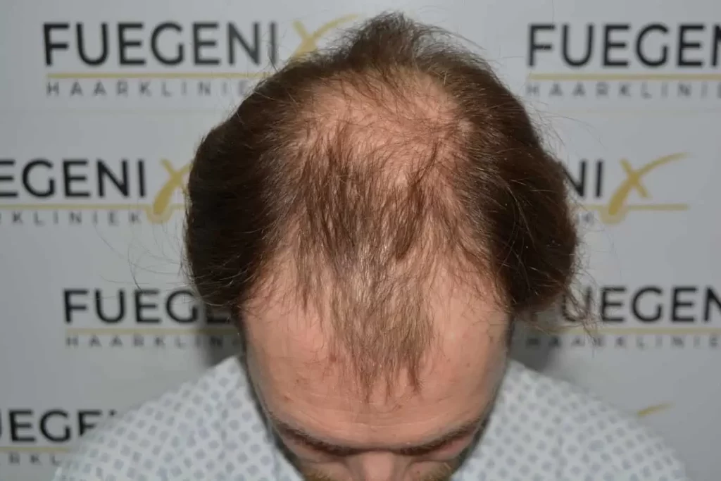 Front Midscalp In One Sitting