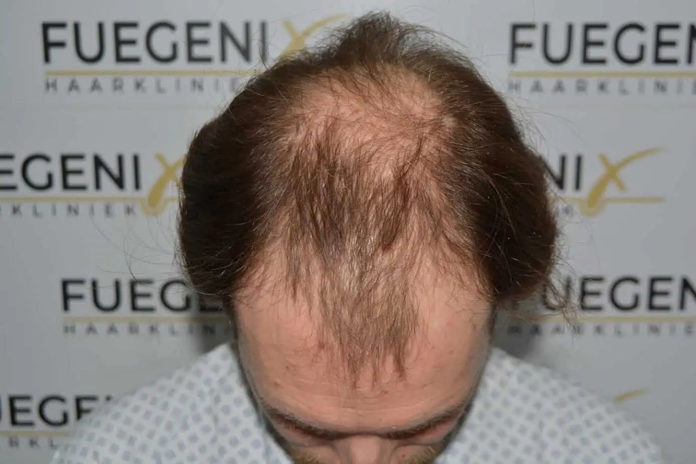 Front midscalp in one sitting — before