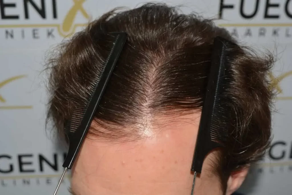 Front Midscalp In One Sitting