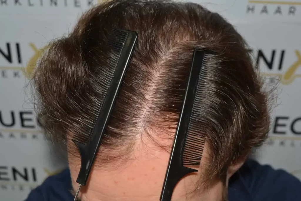 Front Midscalp In One Sitting