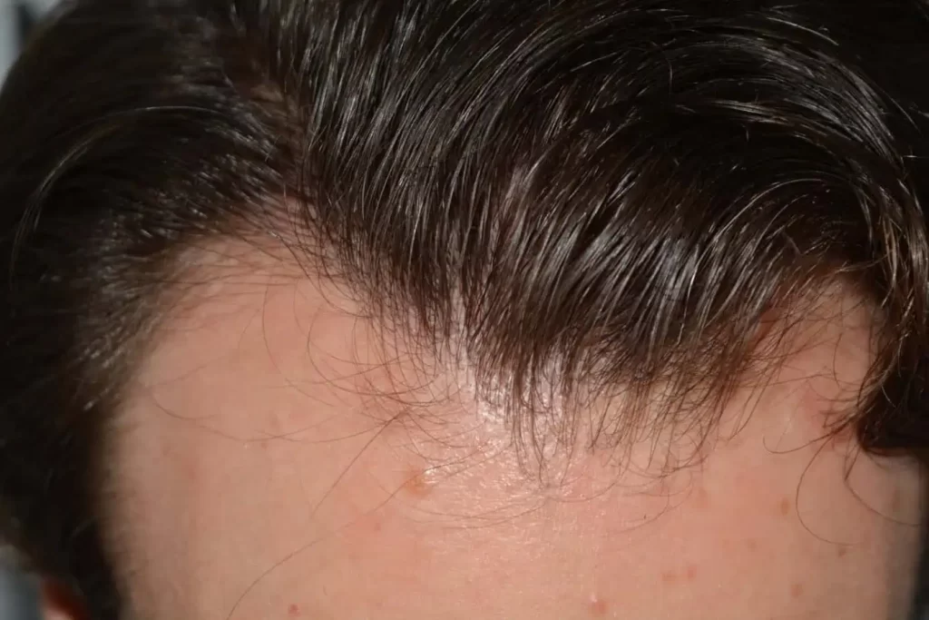 Front Midscalp In One Sitting