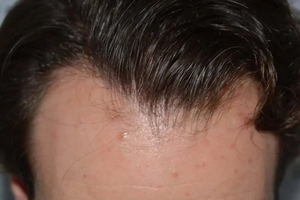Front Midscalp In One Sitting