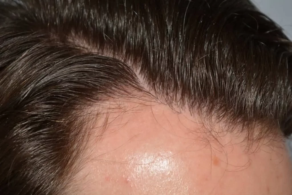Front Midscalp In One Sitting