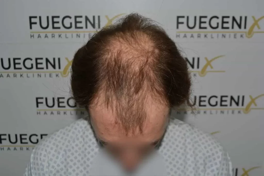 Front Midscalp In One Sitting