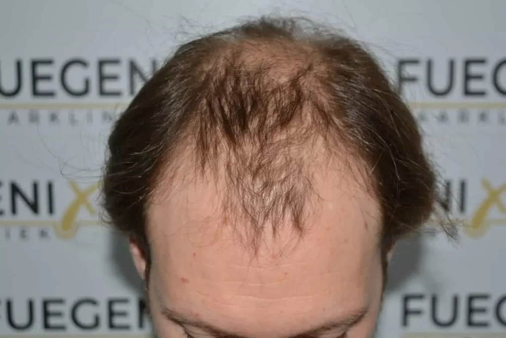 Front Midscalp In One Sitting