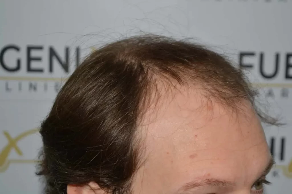 Front Midscalp In One Sitting