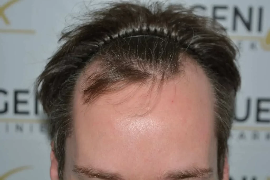 The Henry Cavill Hairline