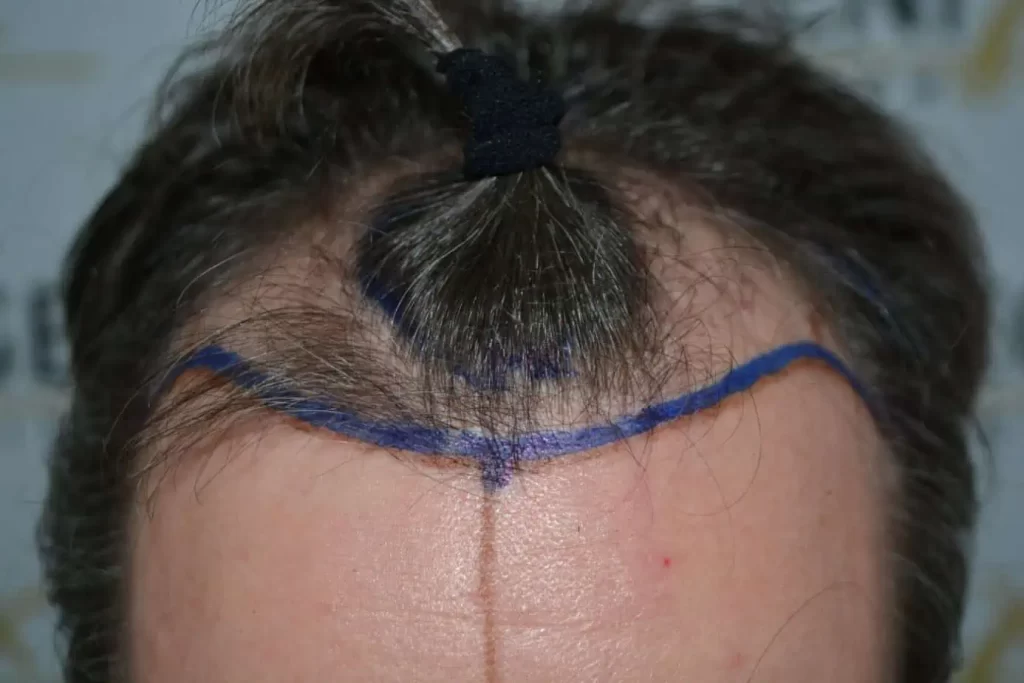 The Henry Cavill Hairline