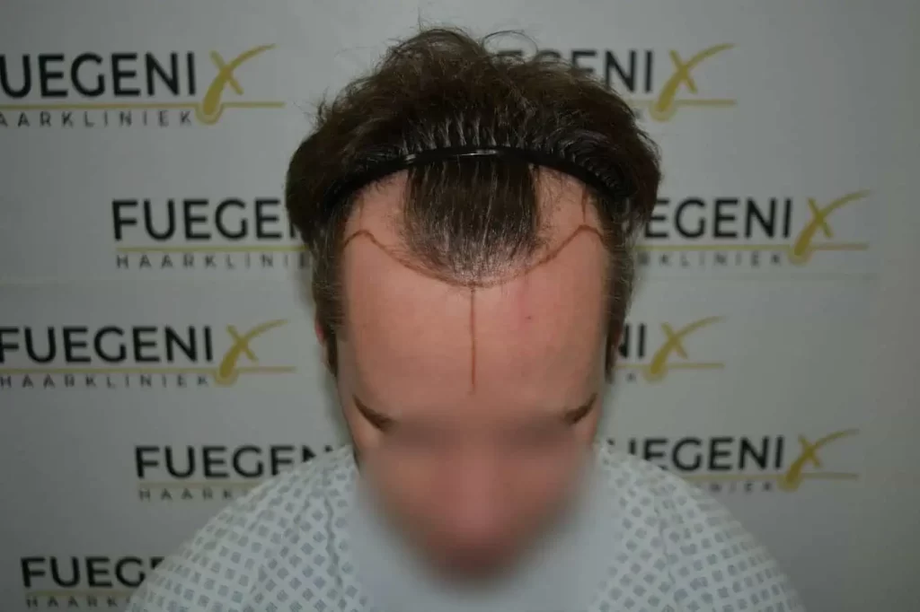 The Henry Cavill Hairline