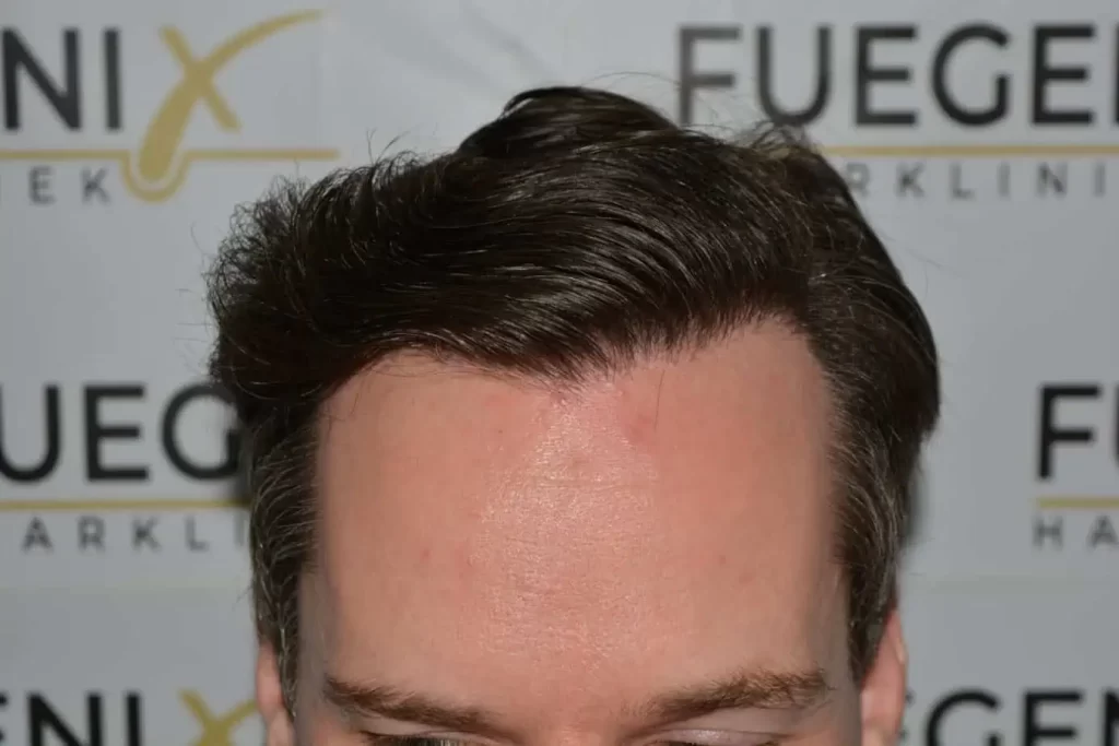 The Henry Cavill Hairline