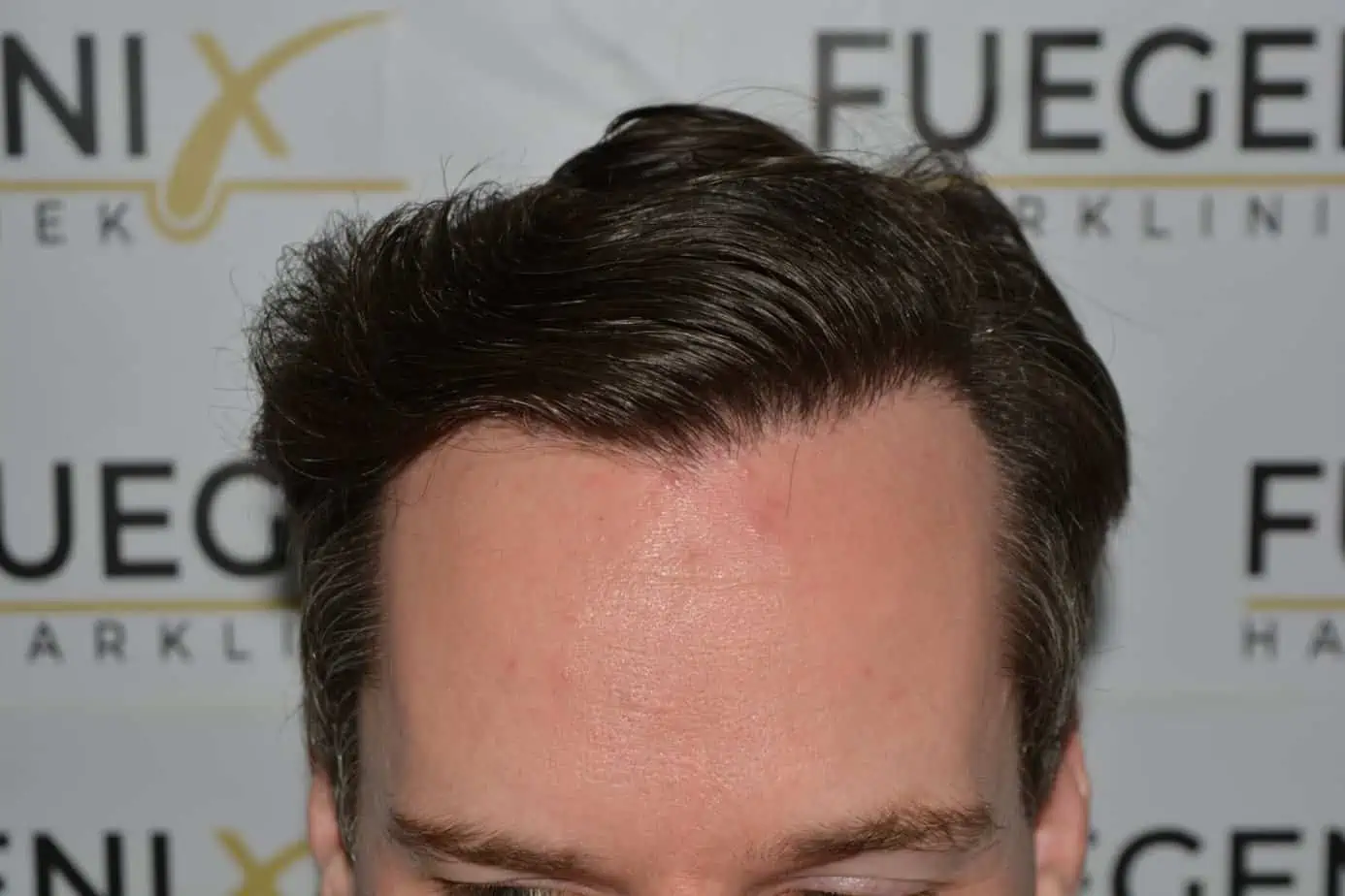 After – The Henry Cavill Hairline