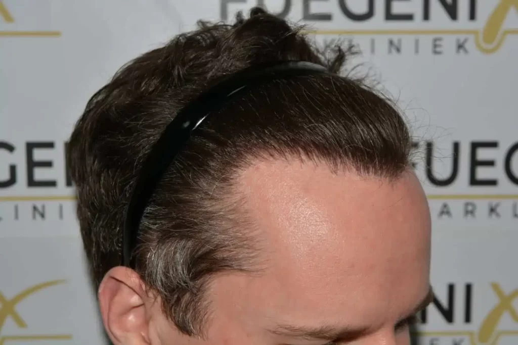 The Henry Cavill Hairline