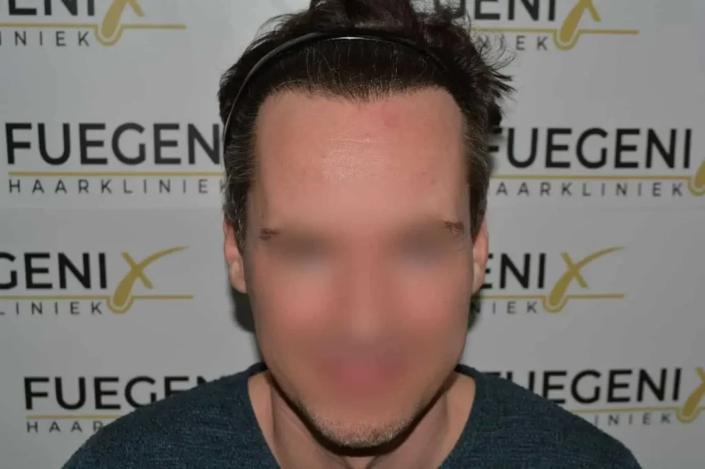 The Henry Cavill Hairline