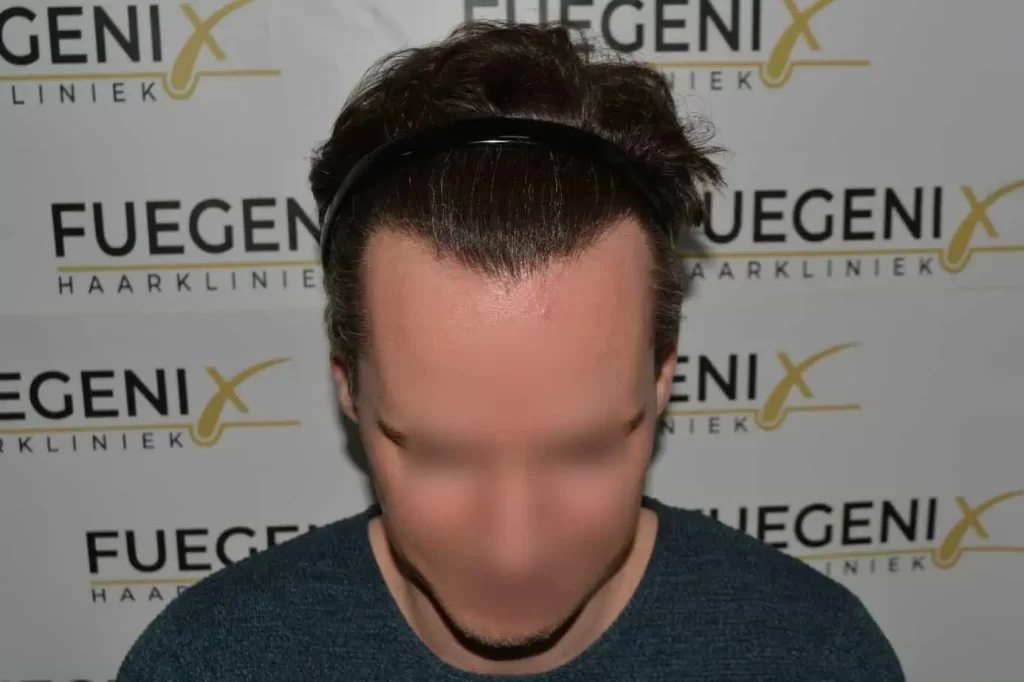 The Henry Cavill Hairline