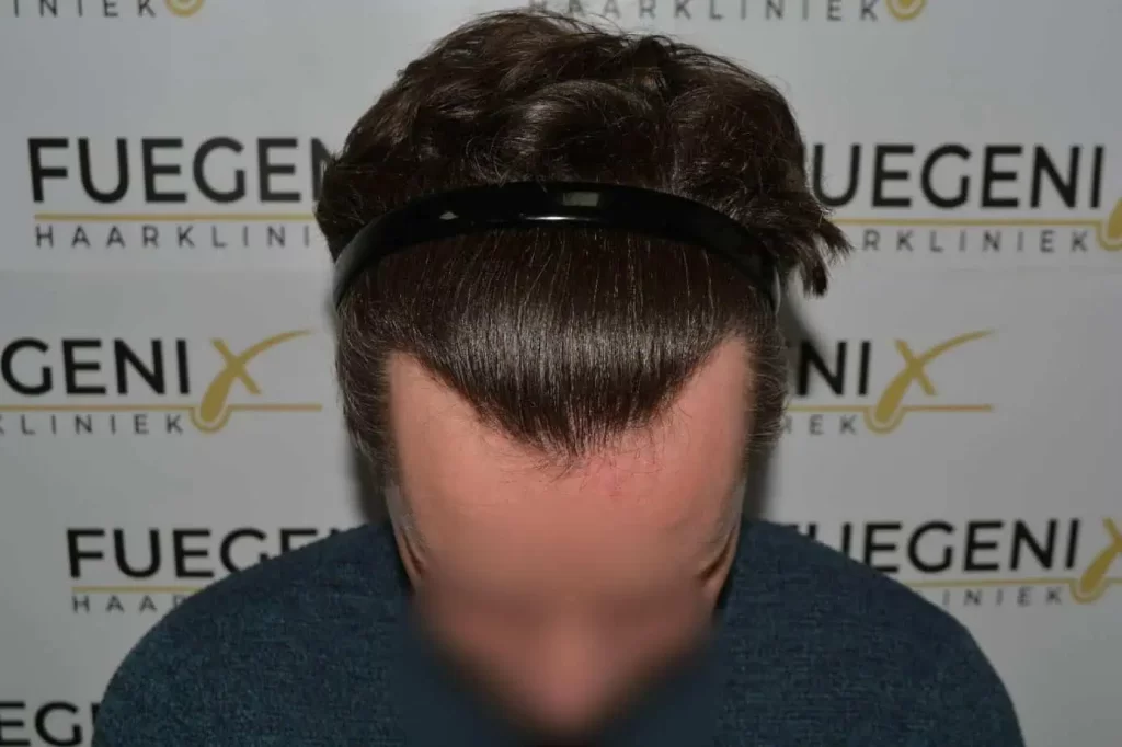 The Henry Cavill Hairline