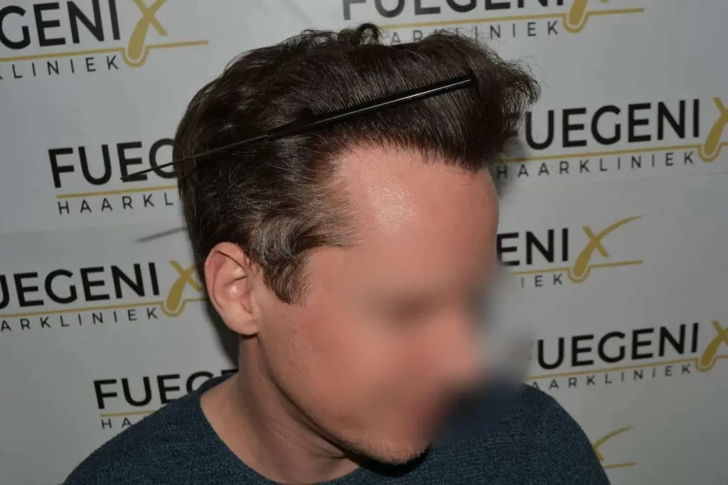 The Henry Cavill Hairline