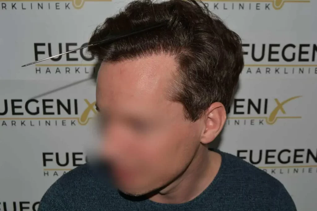 The Henry Cavill Hairline