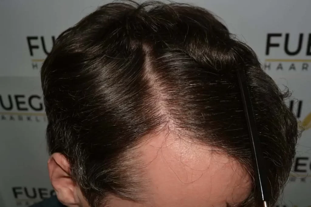 The Henry Cavill Hairline
