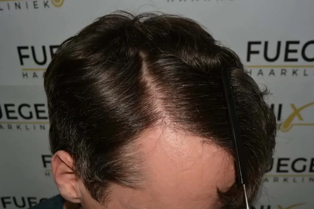 The Henry Cavill Hairline